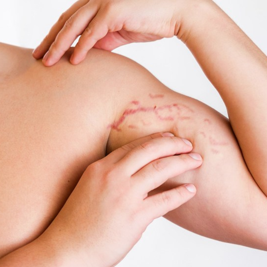 ZIUM Stretch Mark Gel – гель для ухода за растяжками, 15 г