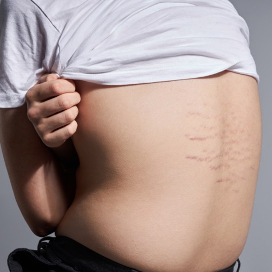 ZIUM Stretch Mark Gel – гель для ухода за растяжками, 15 г